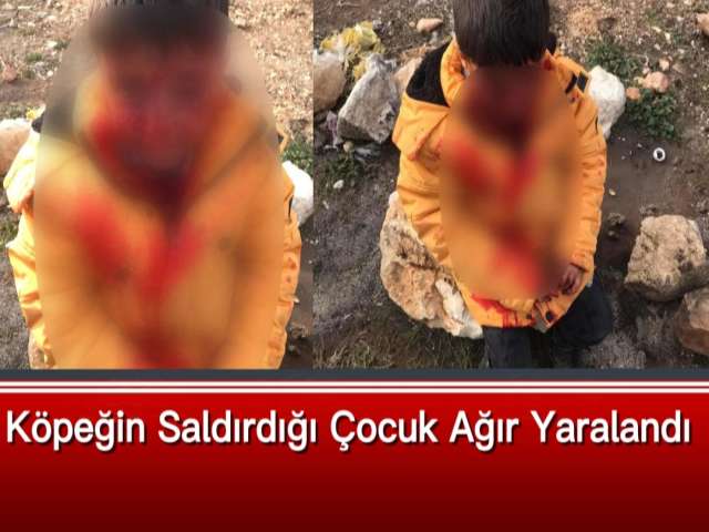 Köpeğin Saldırdığı Çocuk Ağır Yaralandı